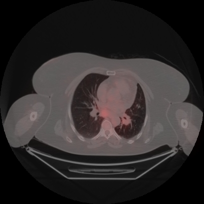 Brain metastasis (Radiopaedia 89847-106962 Axial lung window 30).jpg