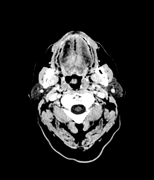 Brain metastasis (large cystic mass) (Radiopaedia 47497-52106 Axial C+ 4).png