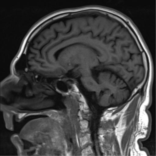 File:Brain metastasis (large cystic mass) (Radiopaedia 47497-52107 Sagittal T1 13).png