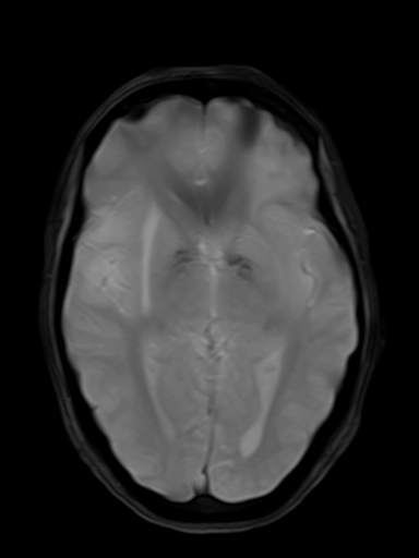 File:Brain metastasis as initial presentation of non-small cell lung cancer (Radiopaedia 65122-74126 Axial T2* 10).jpg