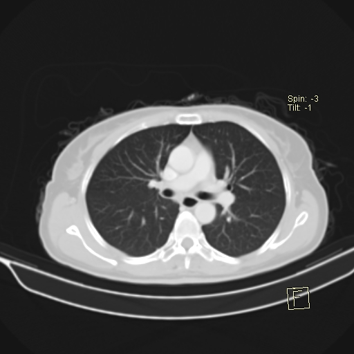 Brain metastasis as initial presentation of non-small cell lung cancer (Radiopaedia 65122-74127 Axial lung window 21).jpg