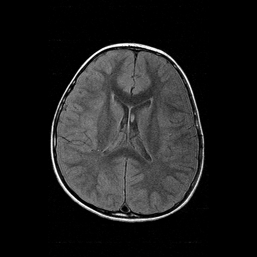 File:Brainstem ganglioglioma (Radiopaedia 10763-11224 Axial FLAIR 8).jpg