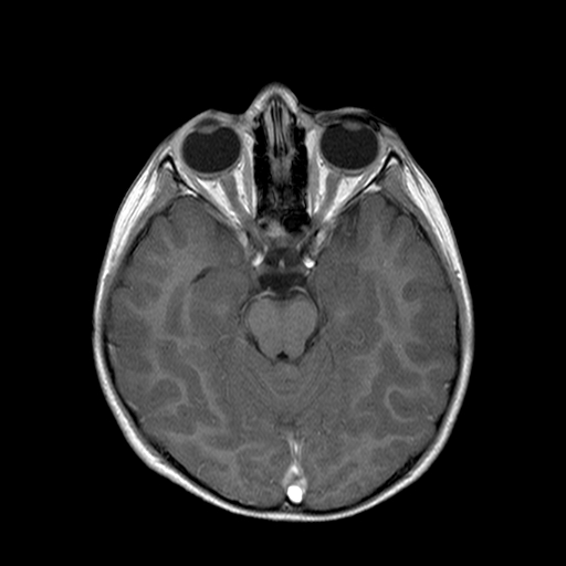 File:Brainstem ganglioglioma (Radiopaedia 10763-11224 Axial T1 C+ 6).jpg