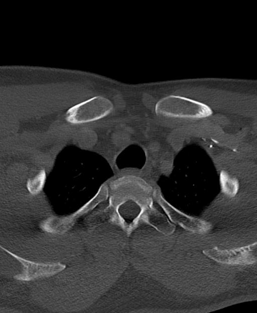 Branchial cleft cyst (Radiopaedia 31167-31875 Axial bone window 72).jpg