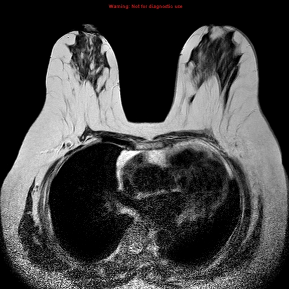 File:Breast carcinoma (multicentric multifocal in mammary Paget disease) (Radiopaedia 50966-56512 Axial T2 8).jpg