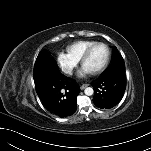 File:Breast carcinoma with pathological hip fracture (Radiopaedia 60314-67974 A 37).jpg