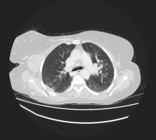 Breast metastases from facial malignant melanoma (Radiopaedia 60316-67975 Axial lung window 38).jpg
