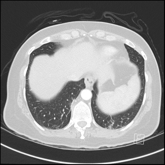 Breast metastases from renal cell cancer (Radiopaedia 79220-92225 Axial lung window 70).jpg
