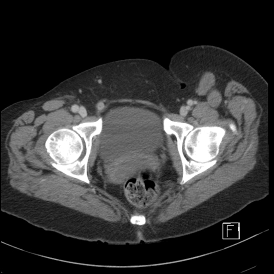 File:Breast metastases from renal cell cancer (Radiopaedia 79220-92225 C 116).jpg