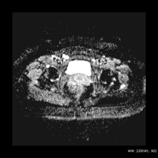 File:Broad ligament fibroid (Radiopaedia 49135-54241 Axial ADC 23).jpg