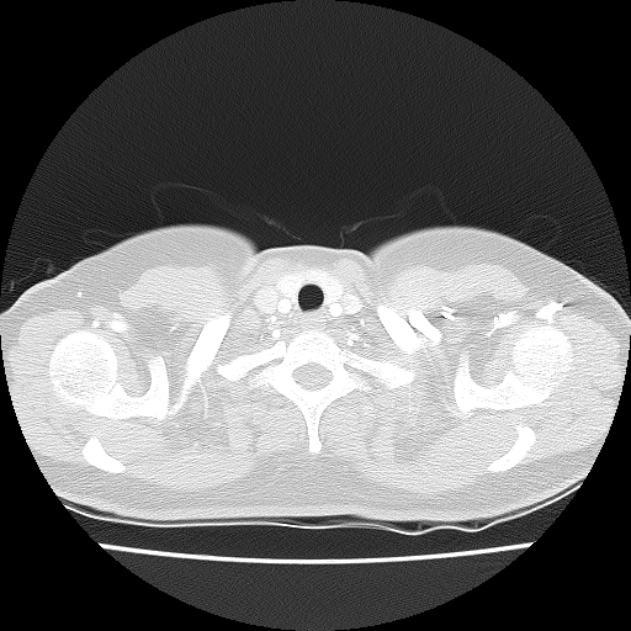 Bronchial atresia (Radiopaedia 22965-22992 Axial lung window 50).jpg