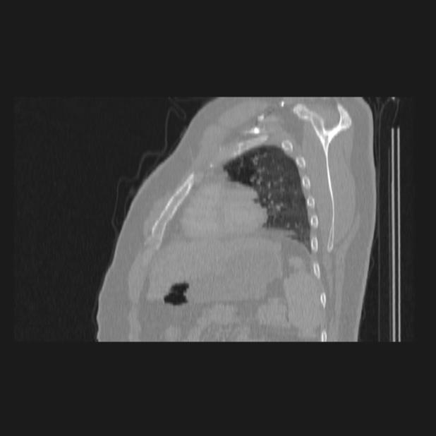 Bronchial atresia (Radiopaedia 60685-68439 Sagittal lung window 71).jpg