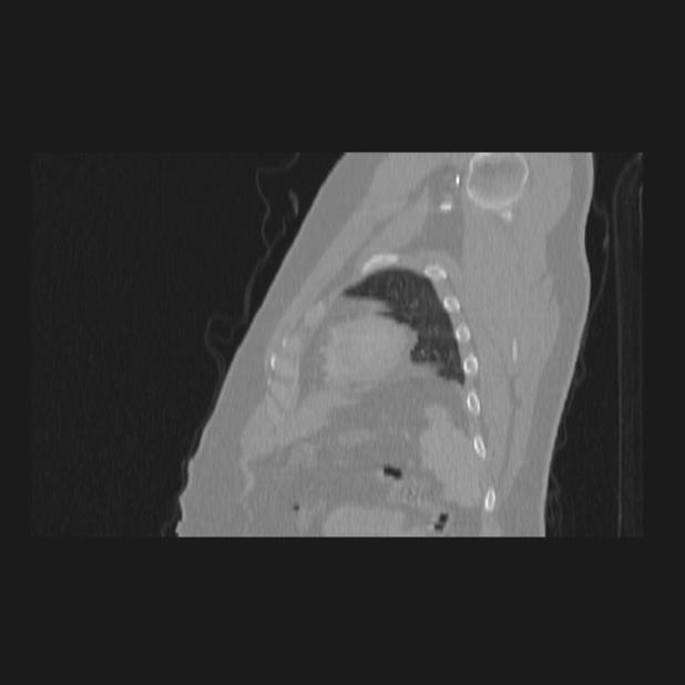 Bronchial atresia (Radiopaedia 60685-68439 Sagittal lung window 83).jpg
