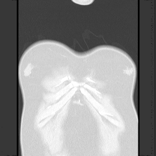 Bronchial carcinoid tumor (Radiopaedia 67377-76764 Coronal lung window 14).jpg