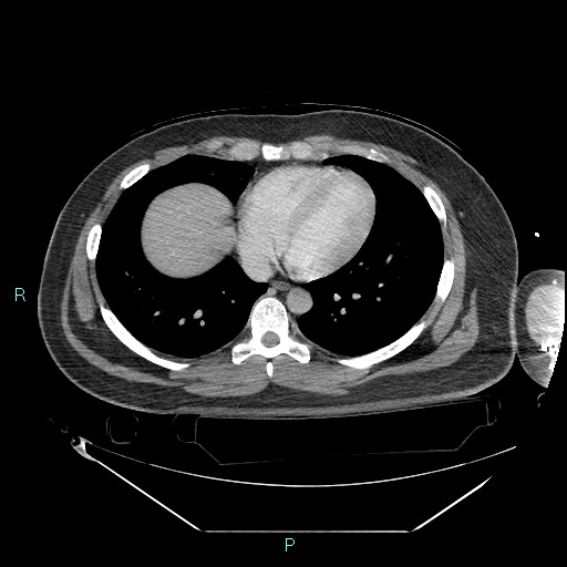 Bronchial carcinoid tumor (Radiopaedia 78272-90870 C 82).jpg