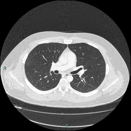 Bronchial carcinoid tumor (Radiopaedia 78272-90875 Axial lung window 22).jpg