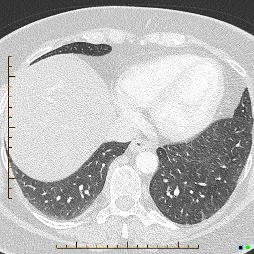 Bronchial diverticula (Radiopaedia 79512-92676 Axial lung window 160).jpg