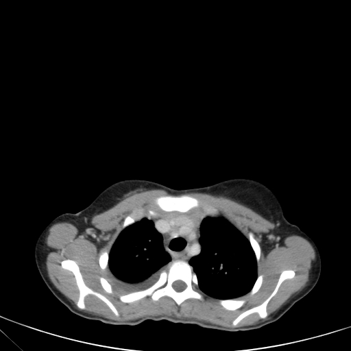 Bronchial mucoepidermoid carcinoma (Radiopaedia 57023-63895 Axial 26).jpg