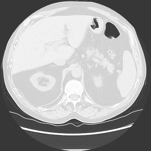 Bronchial stenosis - lung transplant (Radiopaedia 73133-83848 Axial lung window 60).jpg