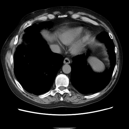 Bronchial stenosis - lung transplant (Radiopaedia 73133-83848 Axial non-contrast 48).jpg