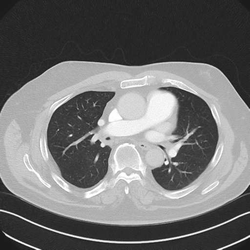 Bronchiectasis (Radiopaedia 39385-41666 Axial lung window 31).png