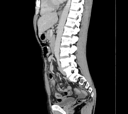 Bronchiectasis in Crohn disease (Radiopaedia 60311-67977 D 63).jpg