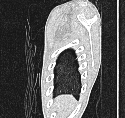 Bronchiolitis obliterans (Radiopaedia 71538-81897 Sagittal lung window 2).jpg