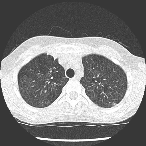 Bronchiolotis obliterans (Radiopaedia 73769-84575 Axial lung window 13).jpg