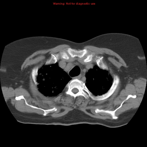 Bronchoalveolar carcinoma (Radiopaedia 13224-13233 Axial non-contrast 9).jpg