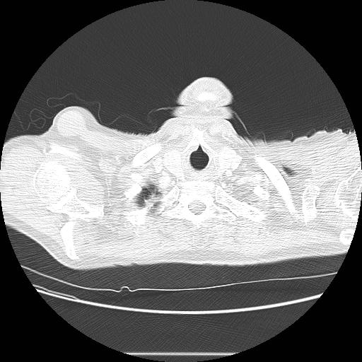 Bronchocele (Radiopaedia 17097-16795 Axial lung window 7).jpg