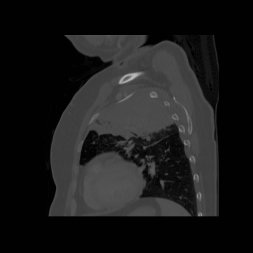 Bronchogenic carcinoma (Radiopaedia 73497-84262 Sagittal bone window 114).jpg