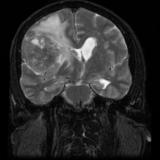 File:Bronchogenic carcinoma brain metastasis (Radiopaedia 9286-9969 Coronal T2 fat sat 1).jpg