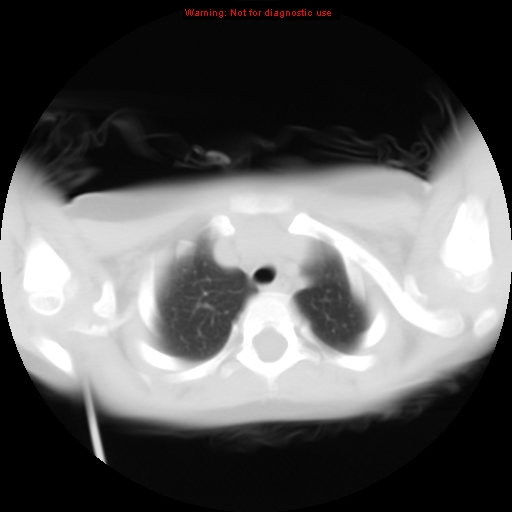 File:Bronchogenic cyst (Radiopaedia 9372-10063 Axial lung window 3).jpg