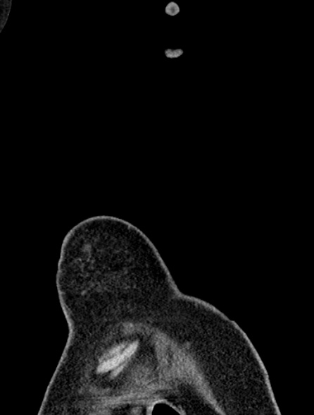 Bronchus suis (Radiopaedia 39631-41953 Coronal non-contrast 3).jpg