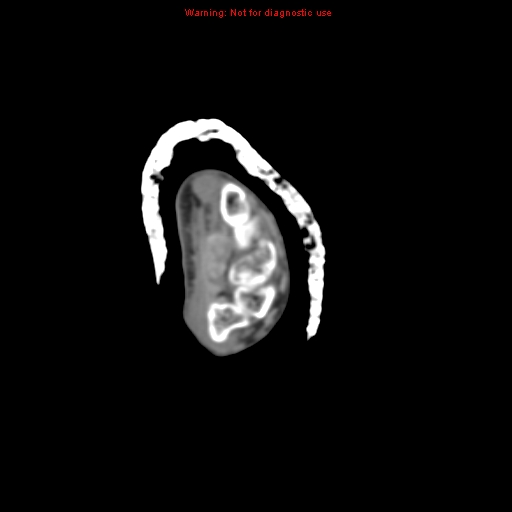 Brown tumor (Radiopaedia 12460-12694 Axial non-contrast 3).jpg