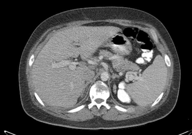Brown tumors compressing the spinal cord (Radiopaedia 68442-77988 E 31).jpg