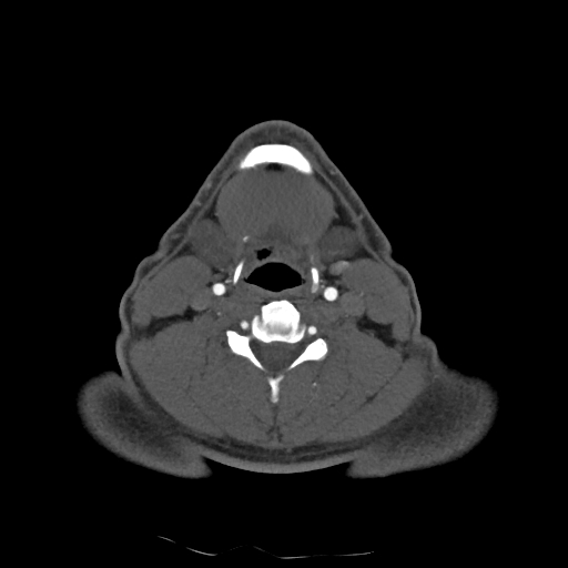 Buccal fat pad arteriovenous malformation (Radiopaedia 70936-81144 A 72).jpg