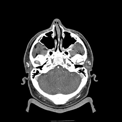 Buccal fat pad arteriovenous malformation (Radiopaedia 70936-81144 D 252).jpg