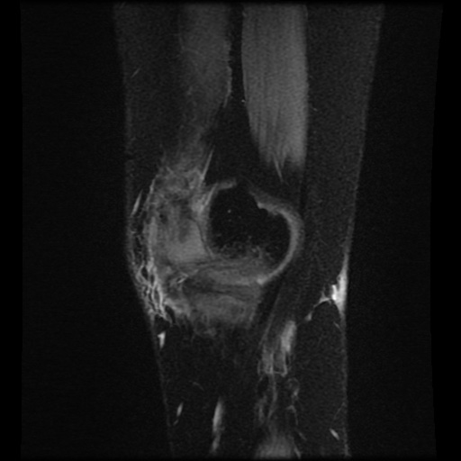 Bucket handle meniscus tear (Radiopaedia 56916-63751 H 77).jpg