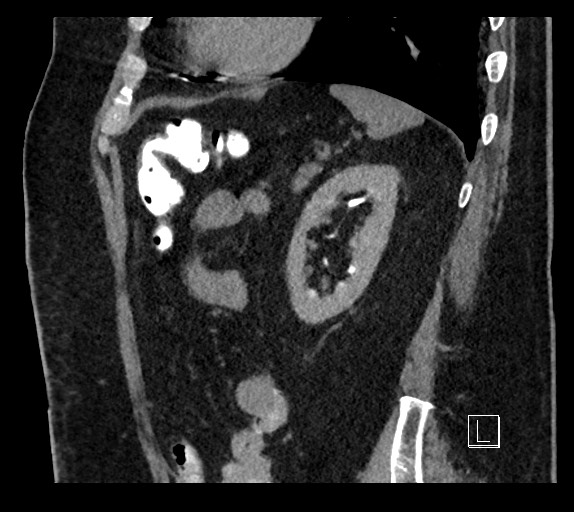Buried bumper syndrome - gastrostomy tube (Radiopaedia 63843-72577 Sagittal Inject 32).jpg