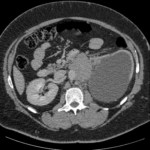 Burned-out testicular seminoma - retroperitoneal nodal metastases (Radiopaedia 62872-71245 A 30).jpg
