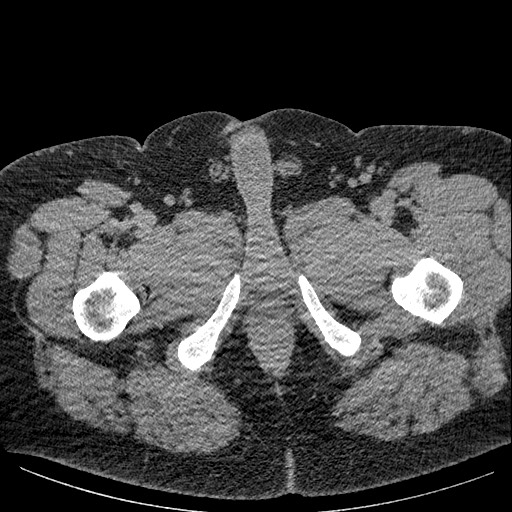 File:Burned-out testicular seminoma - retroperitoneal nodal metastases (Radiopaedia 62872-71245 A 77).jpg