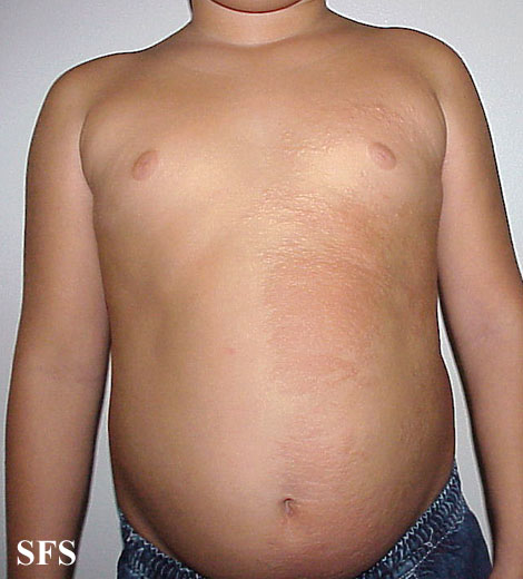 Buschke-Ollendorf Syndrome (Dermatology Atlas 1).jpg