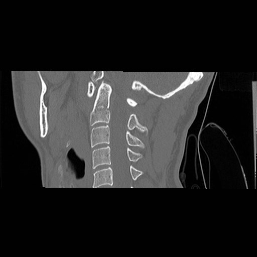 File:C1-C2 "subluxation" - normal cervical anatomy at maximum head rotation (Radiopaedia 42483-45607 C 33).jpg