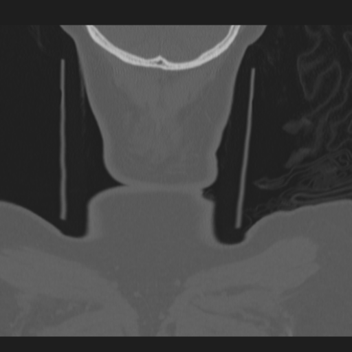 C2 fracture (Radiopaedia 34091-35341 Coronal bone window 67).png