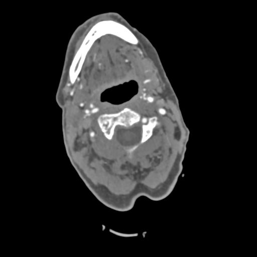 File:C2 fracture with vertebral artery dissection (Radiopaedia 37378-39200 A 160).png