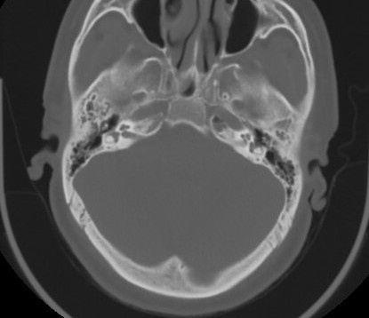 C7 laminar fracture and Klippel-Feil syndrome (Radiopaedia 86710-102850 Axial bone window 11).jpg