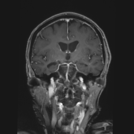 CNS lymphoma with steroid response (Radiopaedia 37980-39921 Coronal T1 C+ 22).png