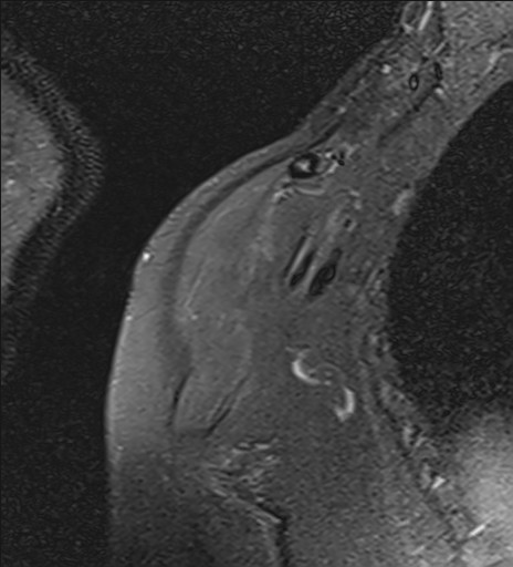 File:Calcific tendinitis of the infraspinatus tendon (Radiopaedia 87256-103537 Coronal PD fat sat 2).jpg