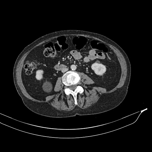 Calcified adrenal glands and Spigelian hernia (Radiopaedia 49741-54988 A 118).jpg